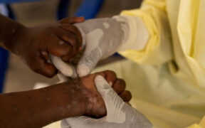 africana.news-Mpox and the Dangers of Treating Some Lives as Disposable